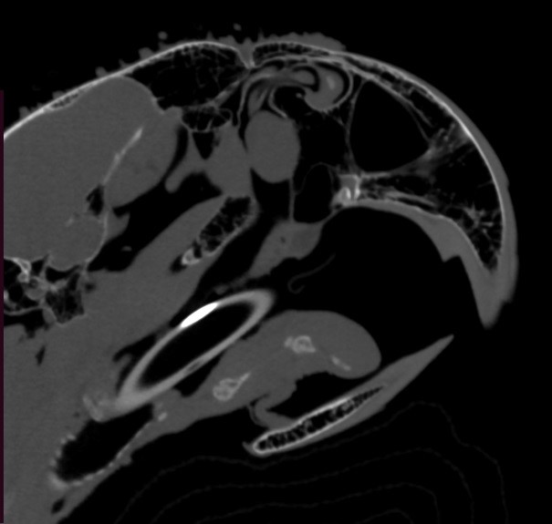 CT Scan CT Scan