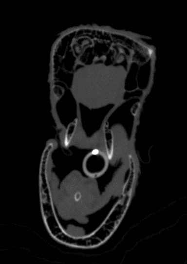 CT Scan CT Scan